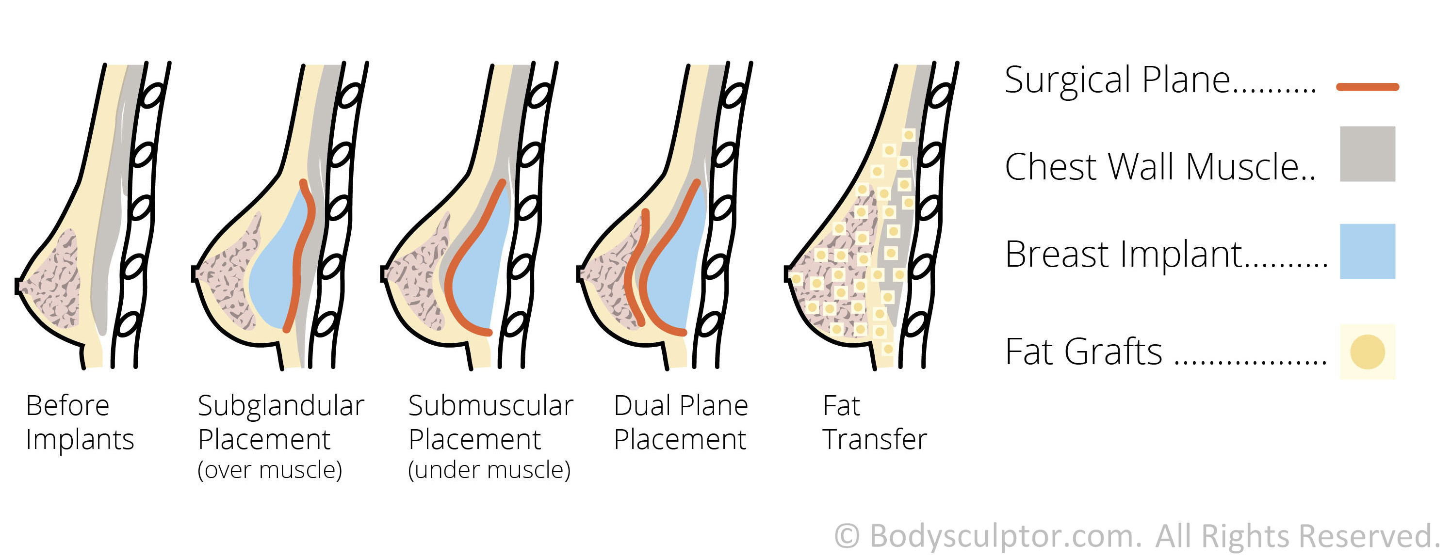 Diagrams Self Breast Massage Implants 80