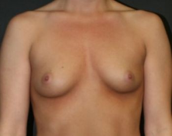 Before & After Breast Augmentation Gallery - Before & After - Dr. Placik