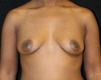 Before & After Breast Augmentation Gallery - Before & After - Dr. Placik