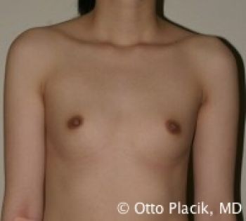 Before & After Breast Augmentation Gallery - Before & After - Dr. Placik