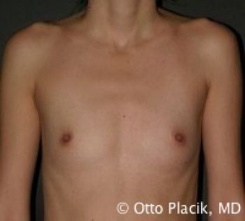 Before & After Breast Augmentation Gallery - Before & After - Dr. Placik
