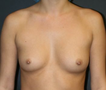 Before & After Breast Augmentation Gallery - Before & After - Dr. Placik