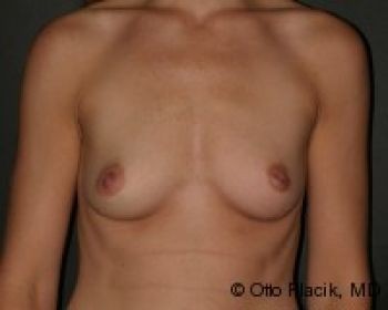 Before & After Breast Augmentation Gallery - Before & After - Dr. Placik