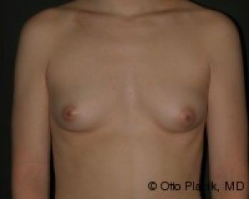 Before & After Breast Augmentation Gallery - Before & After - Dr. Placik