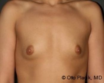 Before & After Breast Augmentation Gallery - Before & After - Dr. Placik