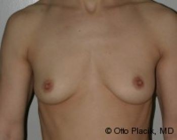 Before & After Breast Augmentation Gallery - Before & After - Dr. Placik