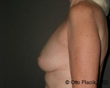 Before & After Breast Augmentation Gallery - Before & After - Dr. Placik