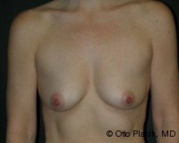 Before & After Breast Augmentation Gallery - Before & After - Dr. Placik