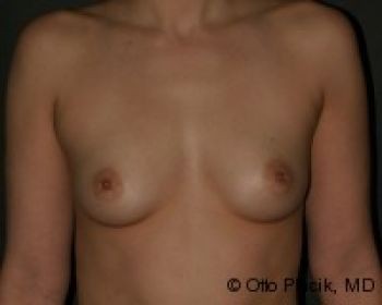 Before & After Breast Augmentation Gallery - Before & After - Dr. Placik