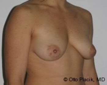 Breast Augmentation Chicago