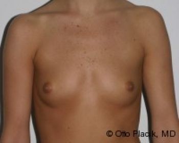 Before & After Breast Augmentation Gallery - Before & After - Dr. Placik