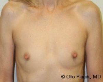 Before & After Breast Augmentation Gallery - Before & After - Dr. Placik