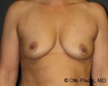 Before & After Breast Augmentation Gallery - Before & After - Dr. Placik