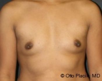 Before & After Breast Augmentation Gallery - Before & After - Dr. Placik