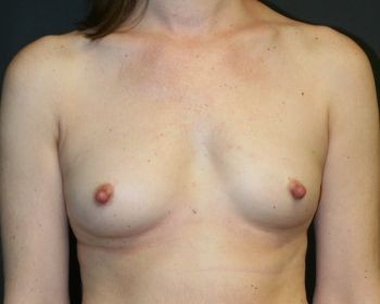 Before & After Breast Augmentation Gallery - Before & After - Dr. Placik