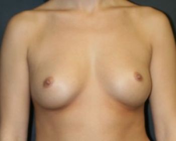 Before & After Breast Augmentation Gallery - Before & After - Dr. Placik