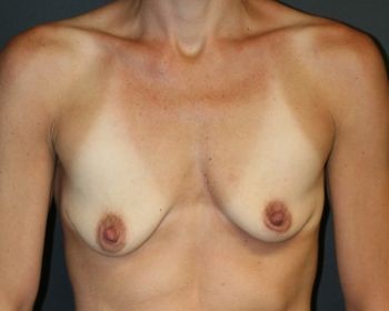 Before & After Breast Augmentation Gallery - Before & After - Dr. Placik