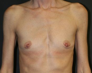 Before & After Breast Augmentation Gallery - Before & After - Dr. Placik