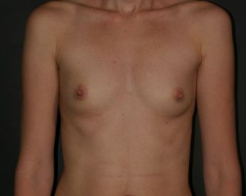 Before & After Breast Augmentation Gallery - Before & After - Dr. Placik