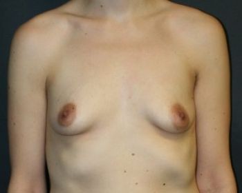 Before & After Breast Augmentation Gallery - Before & After - Dr. Placik