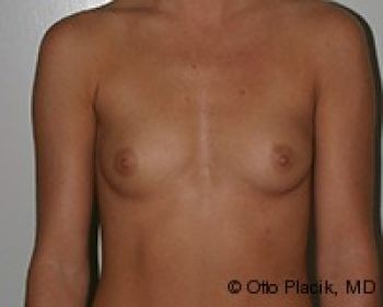 Before & After Breast Augmentation Gallery - Before & After - Dr. Placik