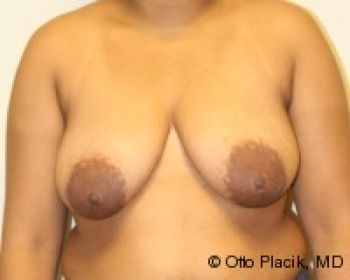 Breast Reduction - Before & After - Dr. Placik