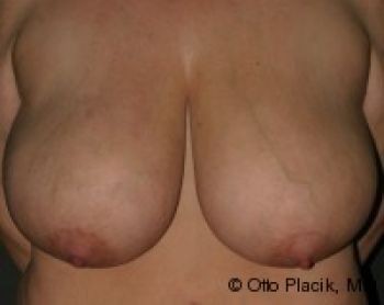 Breast Reduction - Before & After - Dr. Placik