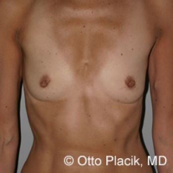 Before & After Breast Augmentation Gallery - Before & After - Dr. Placik