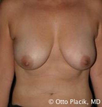 Breast Reduction - Before & After - Dr. Placik