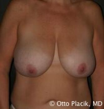 Breast Reduction - Before & After - Dr. Placik