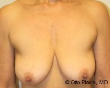 Breast Lift - Before & After - Dr. Placik