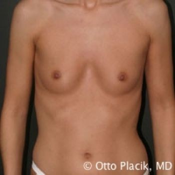 Before & After Breast Augmentation Gallery - Before & After - Dr. Placik