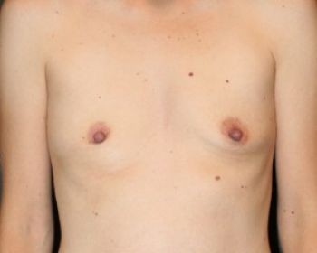 Breast Augmentation with Fat Grafting - Before & After - Dr. Placik