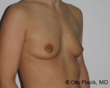 Breast Augmentation