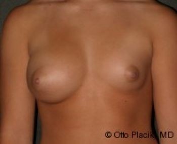 Breast Augmentation with Fat Grafting - Before & After - Dr. Placik