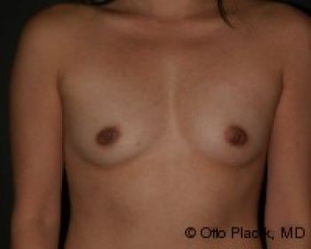 Breast Augmentation with Fat Grafting - Before & After - Dr. Placik