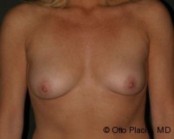 Breast Augmentation with Fat Grafting - Before & After - Dr. Placik