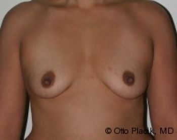 Breast Augmentation with Fat Grafting - Before & After - Dr. Placik