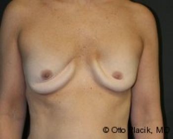 Breast Augmentation with Fat Grafting - Before & After - Dr. Placik