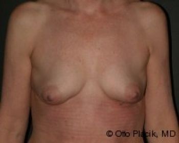 Breast Augmentation with Fat Grafting - Before & After - Dr. Placik