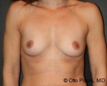 Breast Augmentation with Fat Grafting - Before & After - Dr. Placik