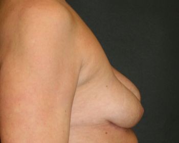 Breast Augmentation with Fat Grafting Chicago