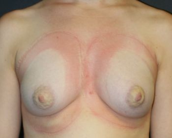 Breast Augmentation with Fat Grafting - Before & After - Dr. Placik