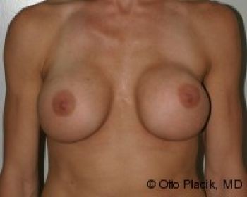 Breast Revision - Before & After - Dr. Placik