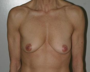 Breast Revision - Before & After - Dr. Placik