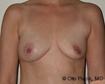 Breast Revision - Before & After - Dr. Placik