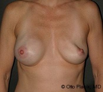 Breast Revision - Before & After - Dr. Placik