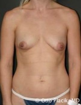 Breast Revision - Before & After - Dr. Placik