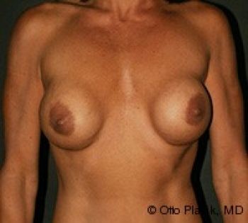 Breast Revision - Before & After - Dr. Placik