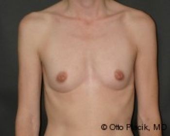 Before & After Breast Augmentation Gallery - Before & After - Dr. Placik